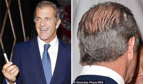 모발이식 성공사례 | 인스티즈