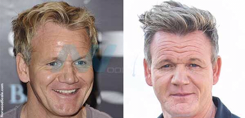 모발이식 성공사례 | 인스티즈