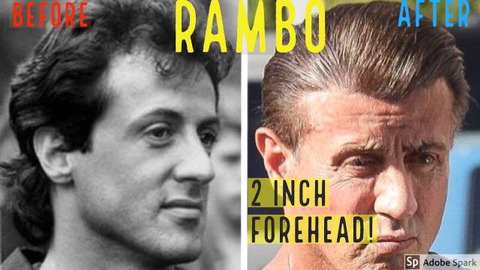 모발이식 성공사례 | 인스티즈