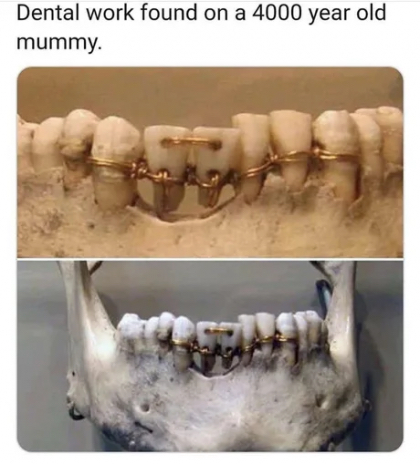4000년전 치과시술 | 인스티즈