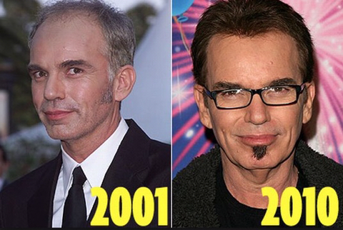 모발이식 성공사례 | 인스티즈