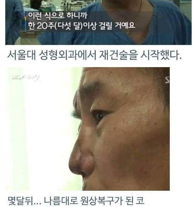 병원 실수로 하루아침에 사지 절단 | 인스티즈
