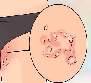 여름에 훈련소가면 많이 걸리는 질병....jpg | 인스티즈