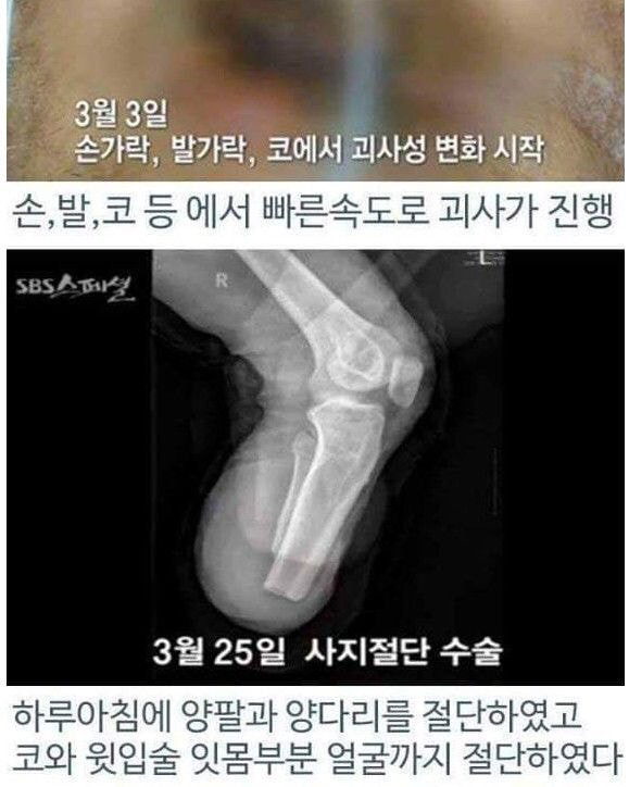 병원 실수로 하루아침에 사지 절단 | 인스티즈
