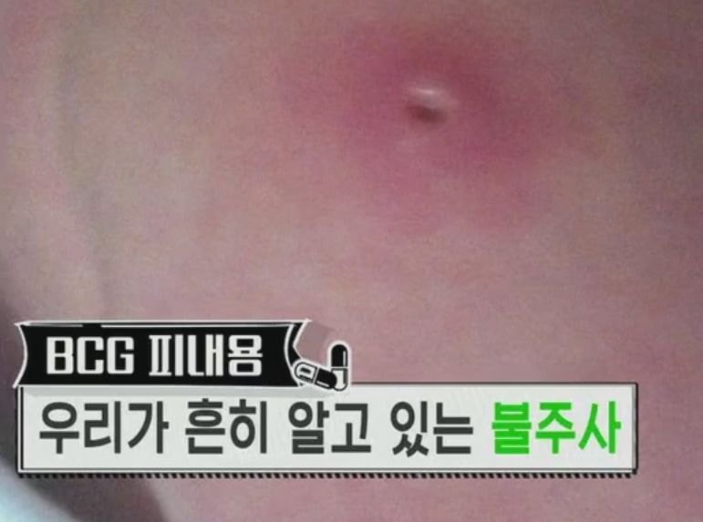 20대 초반 이하만 가지고 있다는 자국 (95년생~2000년생) | 인스티즈