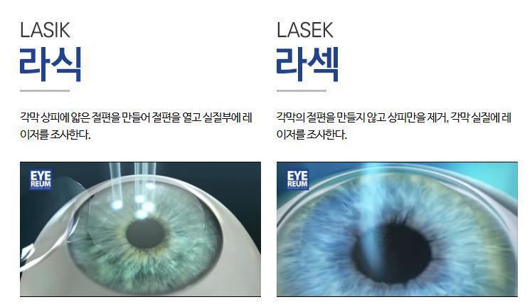 라식,라섹 했던 사람마다 갈리는 것.jpg | 인스티즈