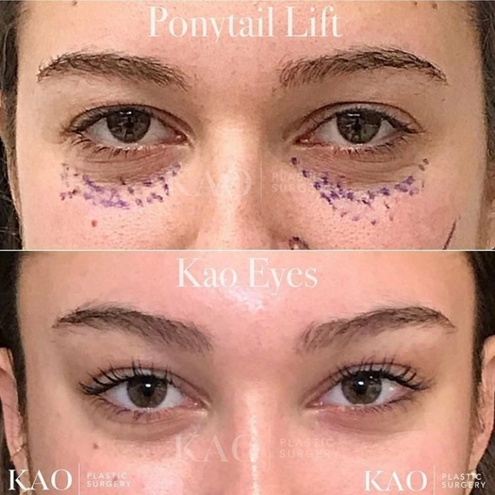 유독 미국인들이 좋아하는 듯한 눈 모양 | 인스티즈