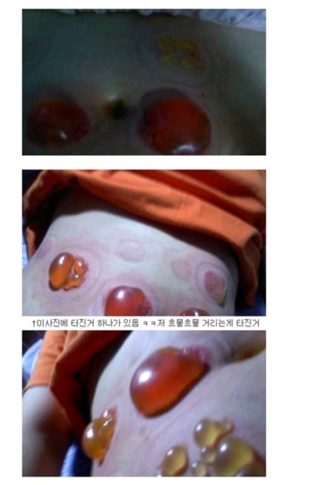 다이어트하다 배에 물집남 | 인스티즈