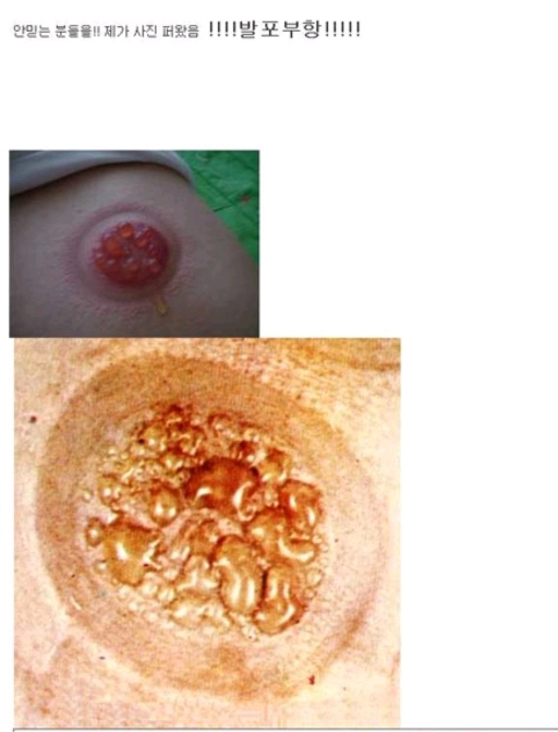 다이어트하다 배에 물집남 | 인스티즈