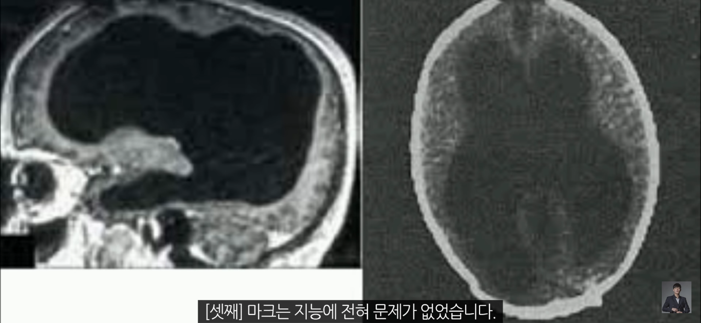 [풀수없는미스테리] 뇌가 없어도 멀쩡한 사람들, 뇌는 필요한 게 맞을까? | 인스티즈