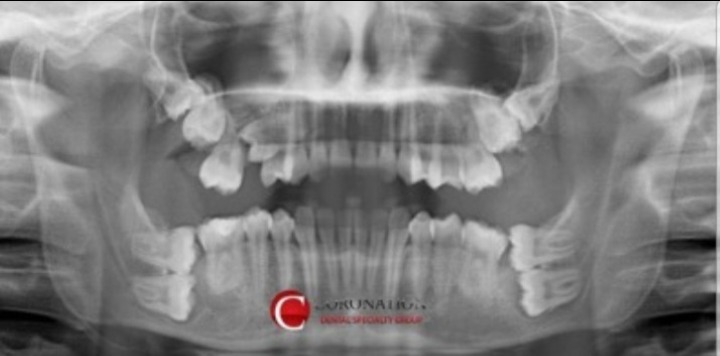 저주받은 사랑니 레전드 | 인스티즈