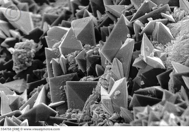 요로결석 확대사진 | 인스티즈