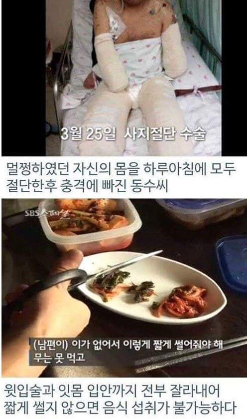 병원 실수로 하루아침에 사지 절단 | 인스티즈