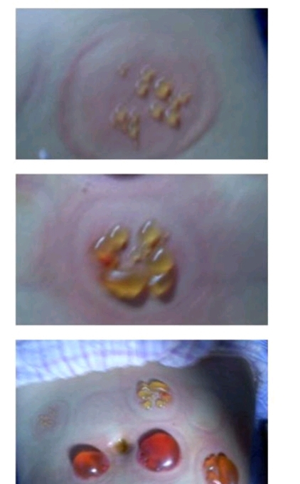 다이어트하다 배에 물집남 | 인스티즈