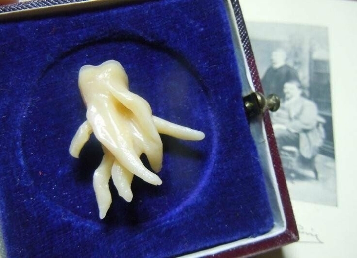 미친 사랑니 ㄷㄷㄷㄷ.JPG | 인스티즈