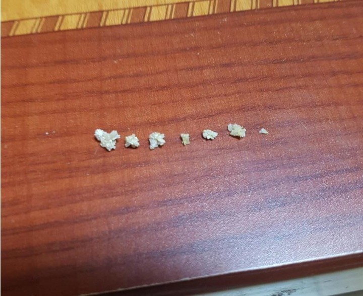 요로결석의 고통 | 인스티즈