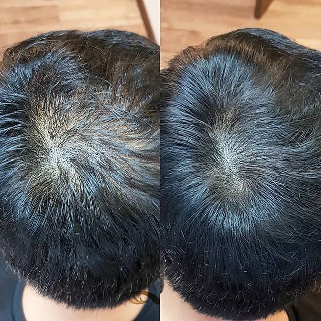 머리숱 없는 사람들이 하고싶어하는 시술.jpg | 인스티즈