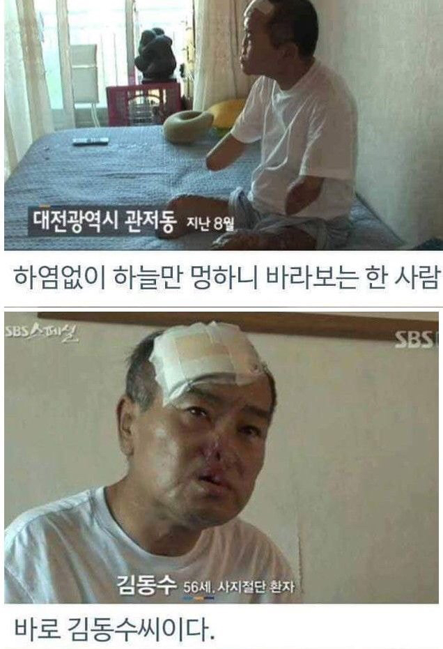 병원 실수로 하루아침에 사지 절단 | 인스티즈