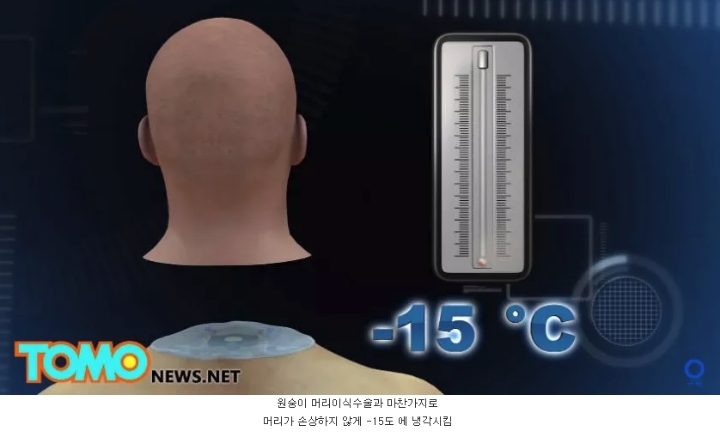 머리 이식 수술...jpg | 인스티즈