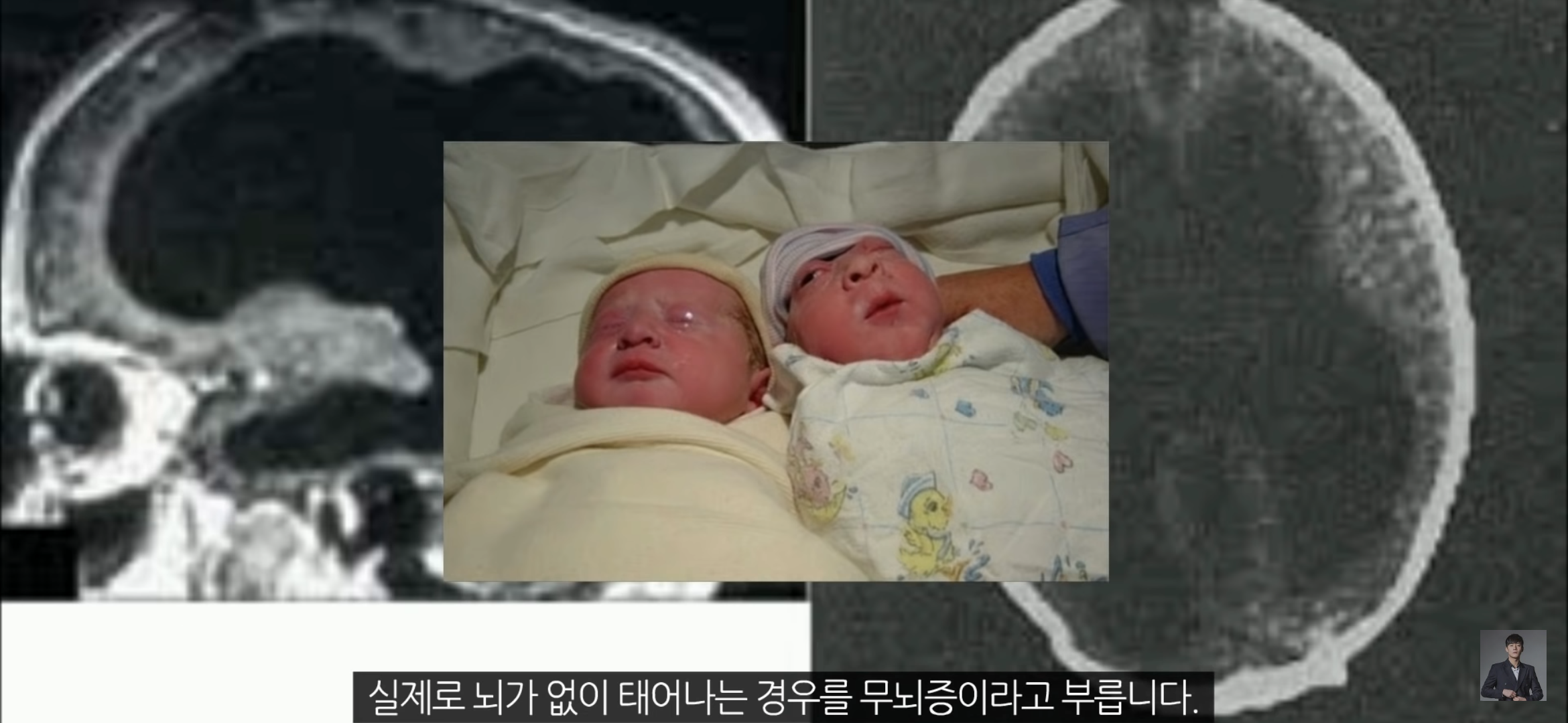 [풀수없는미스테리] 뇌가 없어도 멀쩡한 사람들, 뇌는 필요한 게 맞을까? | 인스티즈