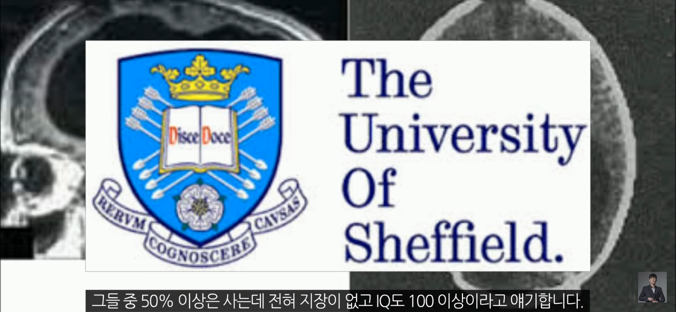 [풀수없는미스테리] 뇌가 없어도 멀쩡한 사람들, 뇌는 필요한 게 맞을까? | 인스티즈