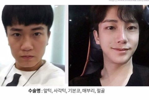 남자 성형수술 레전드.jpg | 인스티즈