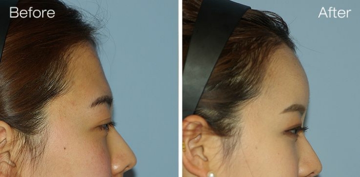 생각보다 많은 여자들이 컴플렉스로 꼽아서 성형 많이 하는 부위 | 인스티즈