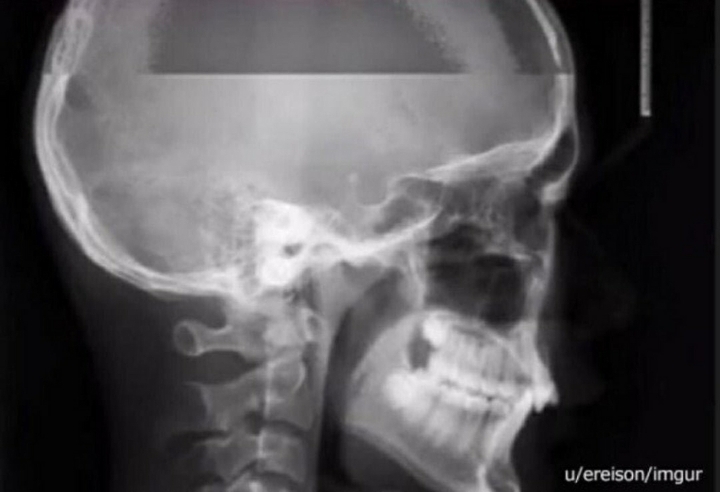 엑스레이찍다가 재채기하면 | 인스티즈