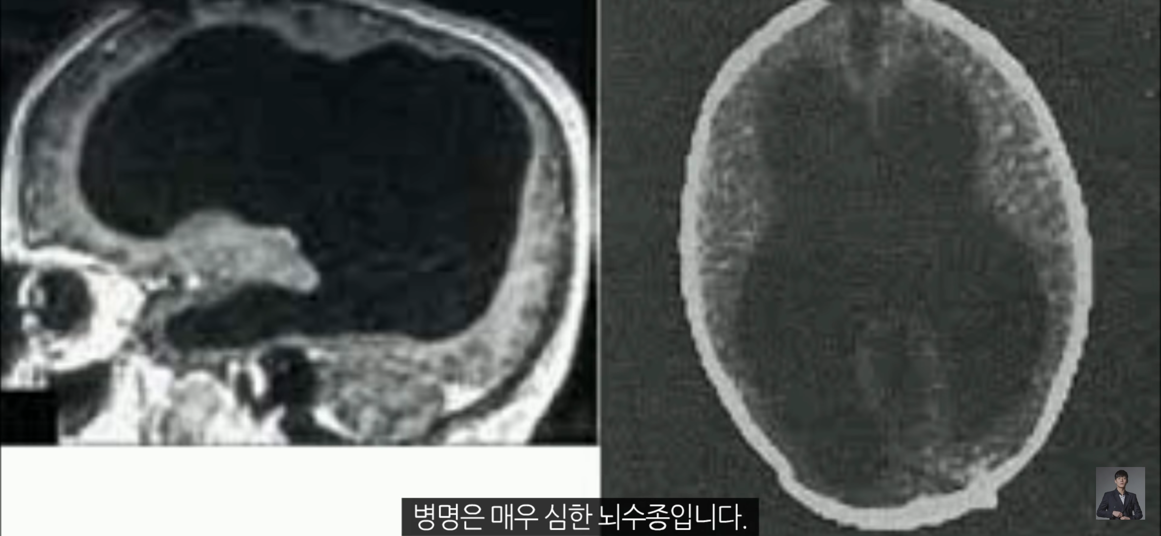 [풀수없는미스테리] 뇌가 없어도 멀쩡한 사람들, 뇌는 필요한 게 맞을까? | 인스티즈