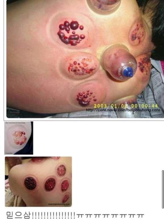 다이어트하다 배에 물집남 | 인스티즈