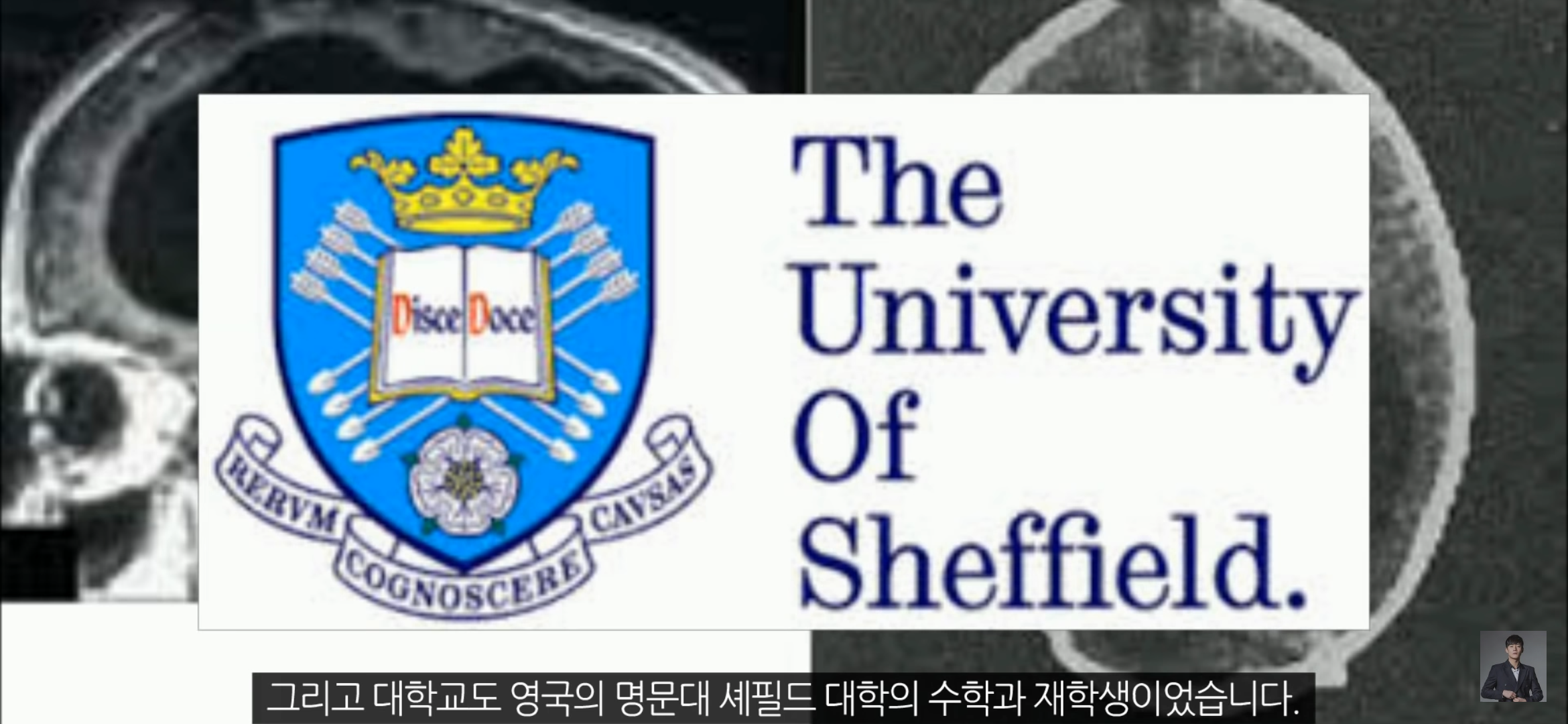 [풀수없는미스테리] 뇌가 없어도 멀쩡한 사람들, 뇌는 필요한 게 맞을까? | 인스티즈