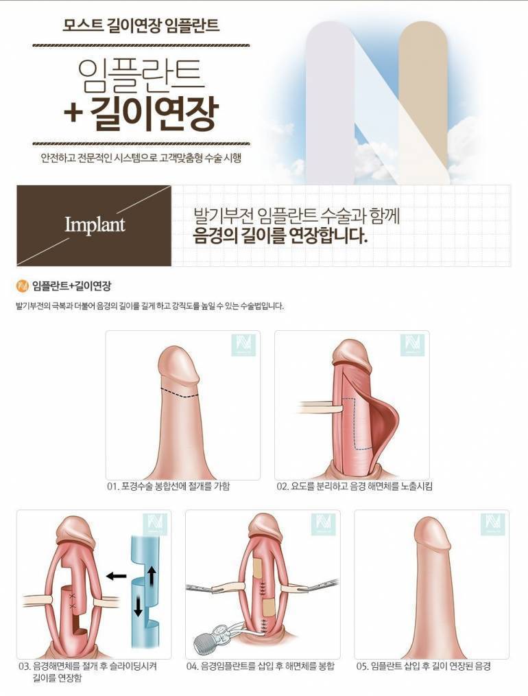 비뇨기과 남자 성기 확대 수술.jpg | 인스티즈