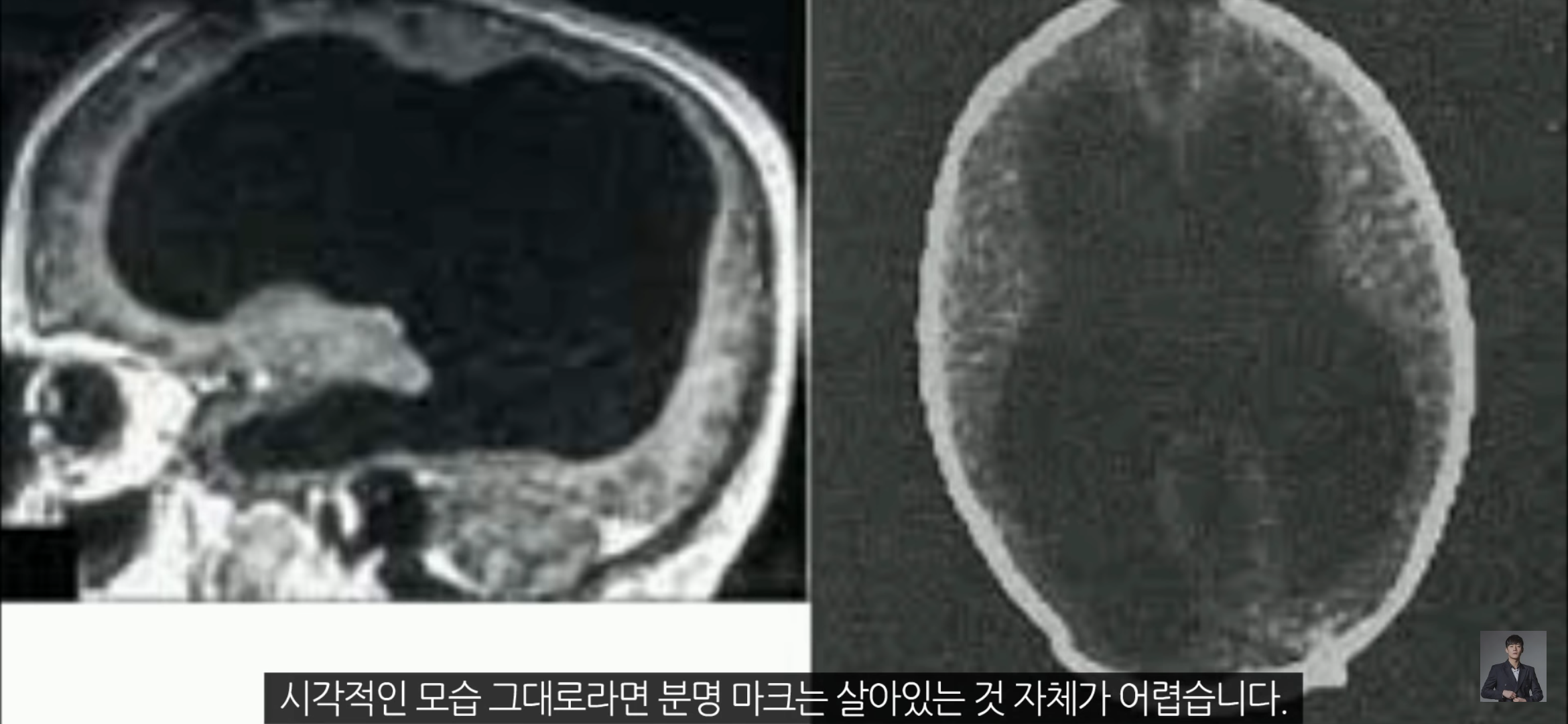 [풀수없는미스테리] 뇌가 없어도 멀쩡한 사람들, 뇌는 필요한 게 맞을까? | 인스티즈