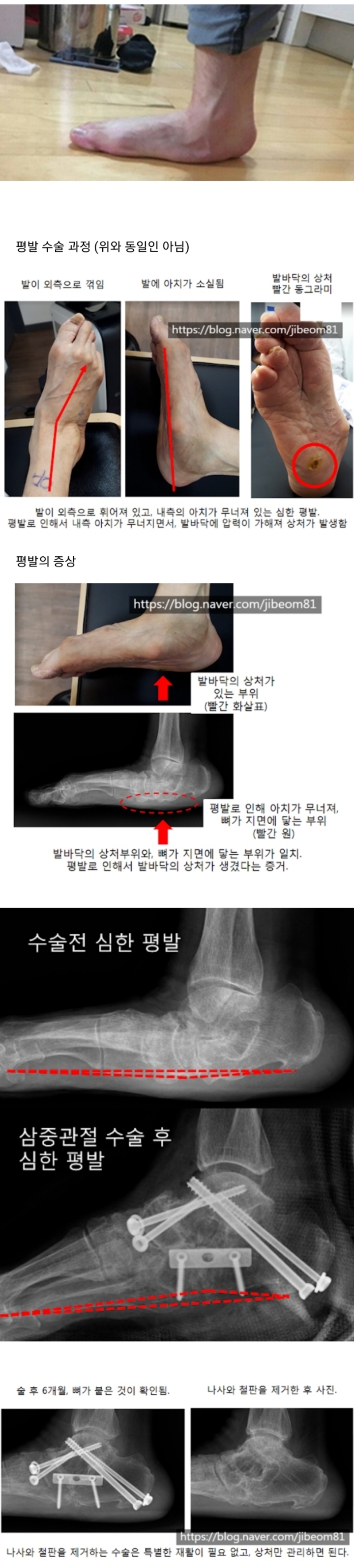 평발 수술 ㄷㄷㄷ., jpg | 인스티즈