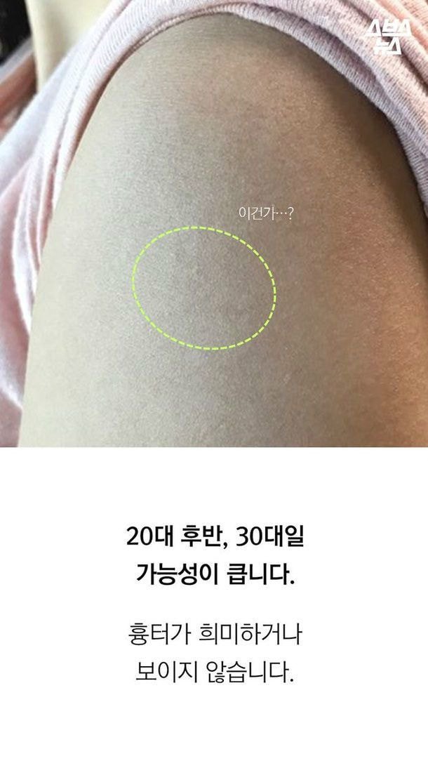 20대 초반 이하만 가지고 있다는 자국 (95년생~2000년생) | 인스티즈