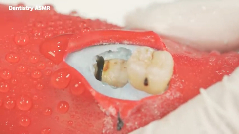 매복 사랑니 발치 ASMR | 인스티즈