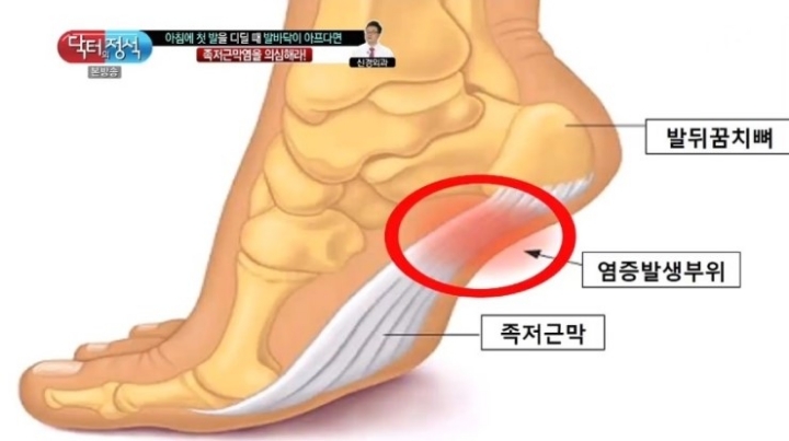발바닥 뒤꿈치쪽 아플때 의심할 수 있는 질병 족저근막염 마사지 방법 + 완화 운동(피지컬갤러리) | 인스티즈