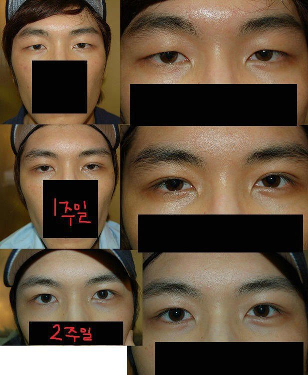 요즘 많이 한다는 남자의 눈성형 | 인스티즈