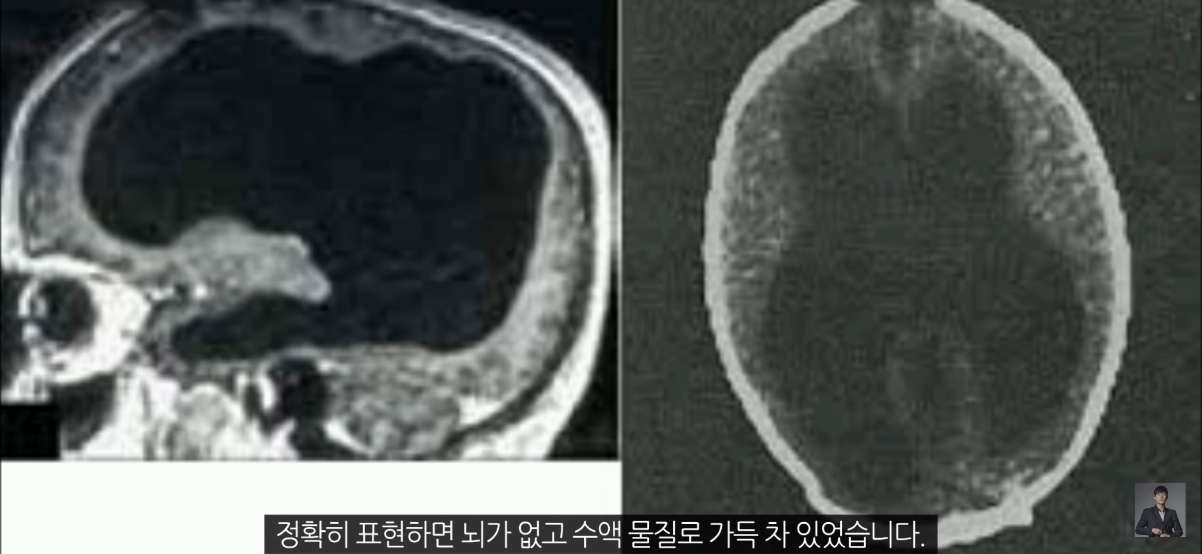 [풀수없는미스테리] 뇌가 없어도 멀쩡한 사람들, 뇌는 필요한 게 맞을까? | 인스티즈