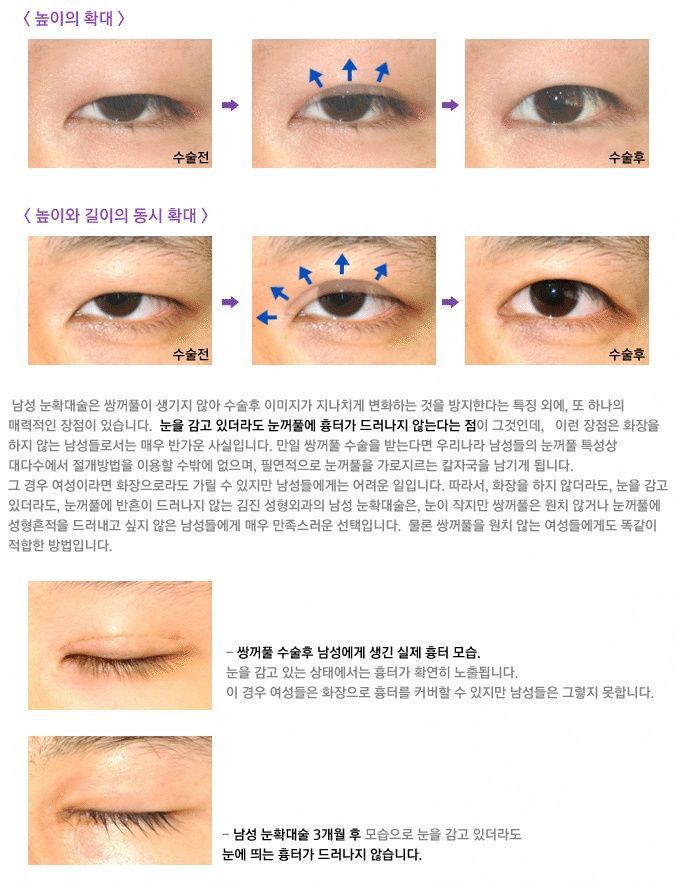 요즘 많이 한다는 남자의 눈성형 | 인스티즈