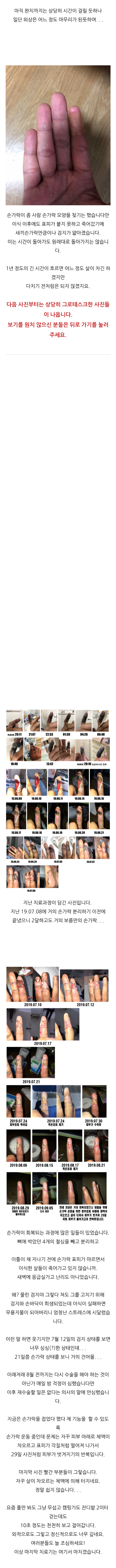 혐주의 쇠 살모사 한테 물린 후기 (스압) | 인스티즈