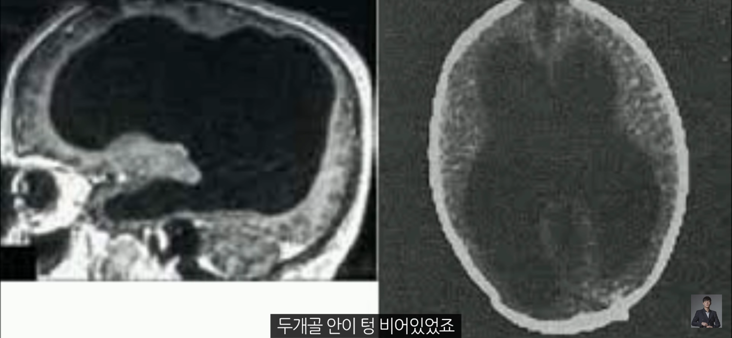 [풀수없는미스테리] 뇌가 없어도 멀쩡한 사람들, 뇌는 필요한 게 맞을까? | 인스티즈