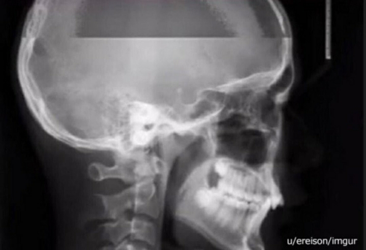 엑스레이 찍다가 재채기 하면 | 인스티즈