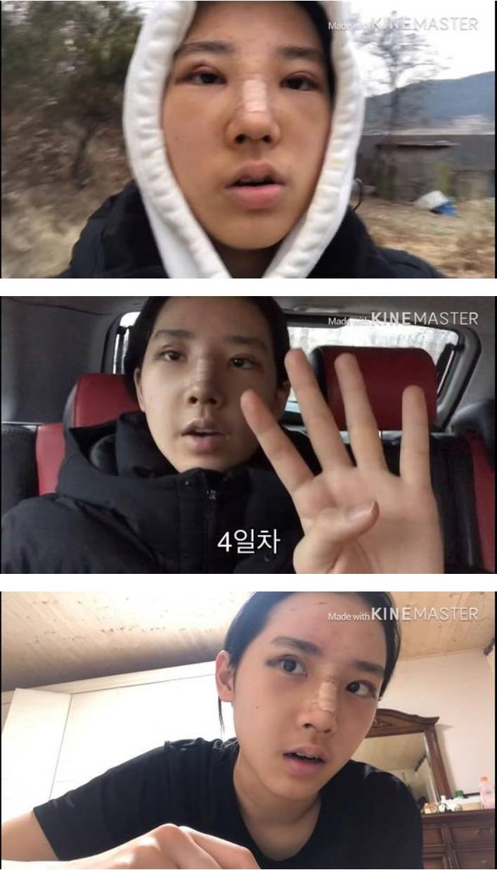 눈코 성형한 여고생 | 인스티즈