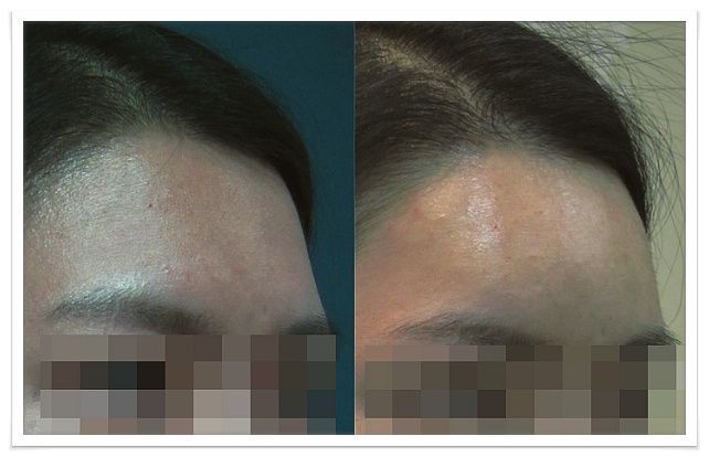 생각보다 많은 여자들이 컴플렉스로 꼽아서 성형 많이 하는 부위 | 인스티즈