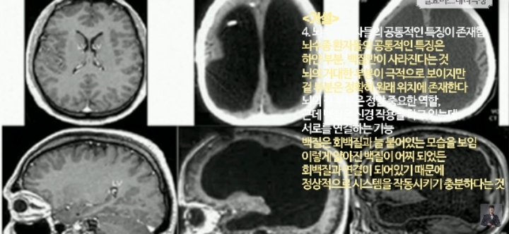 [풀수없는미스테리] 뇌가 없어도 멀쩡한 사람들, 뇌는 필요한 게 맞을까? | 인스티즈