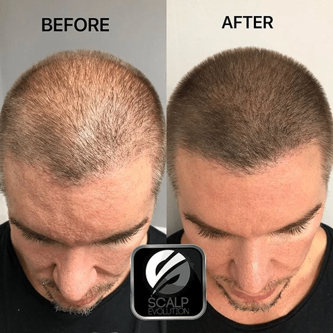 머리숱 없는 사람들이 하고싶어하는 시술.jpg | 인스티즈