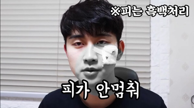 혐주의] 실제로 여드름에 효과적인라는 치료방법 | 인스티즈