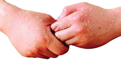 수족냉증+다한증을 둘 다 가진 사람들 빡치는 계절이 다가오고 있음.jpg | 인스티즈