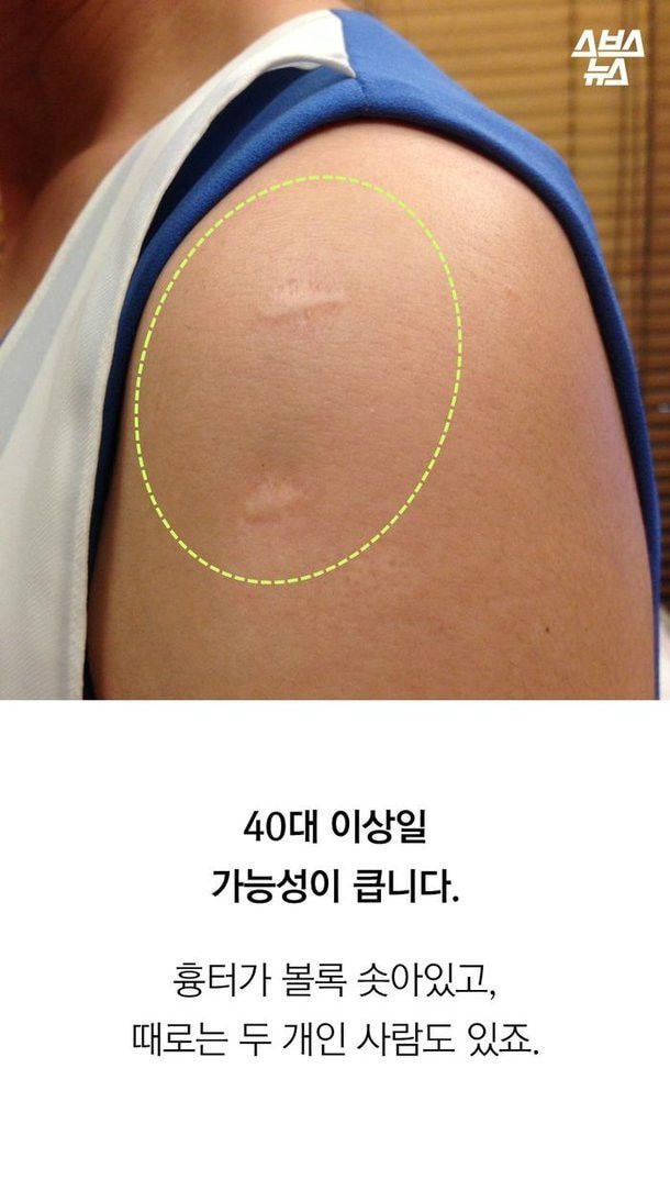 20대 초반 이하만 가지고 있다는 자국 (95년생~2000년생) | 인스티즈